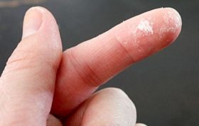جدا کردن چسب از روی پوست